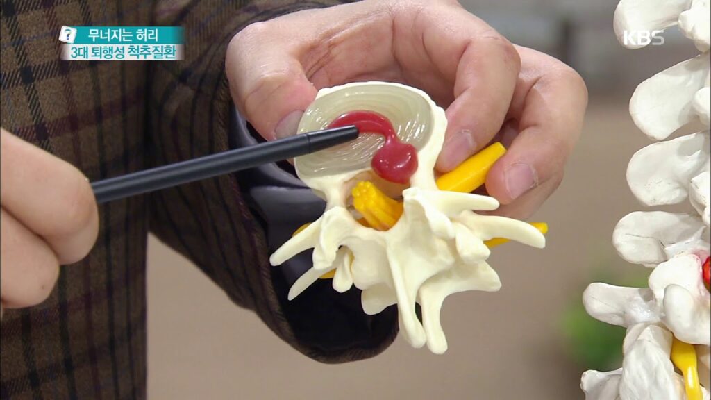 「추간판 [椎間板]」의 한국수어 표현