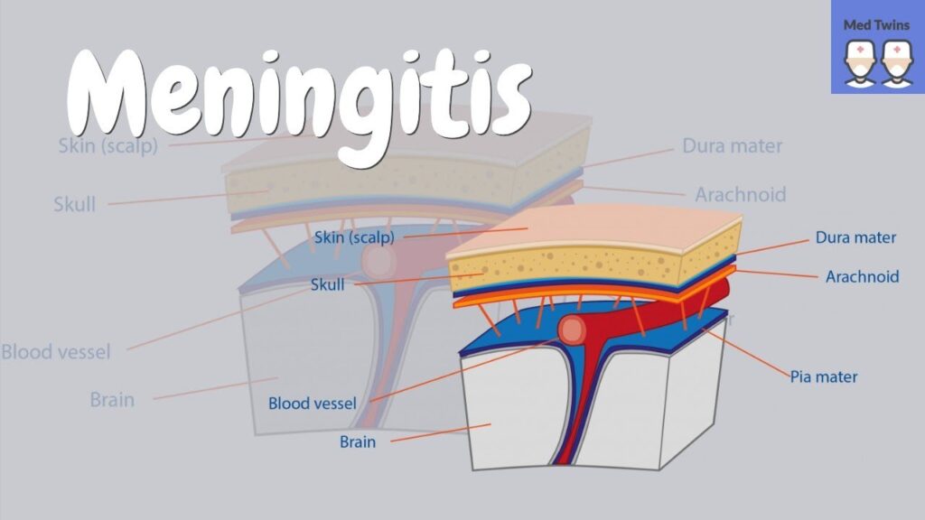 Cómo signar Meningitis en LSE