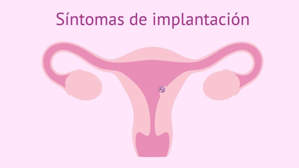 Cómo signar Implantación en LSE